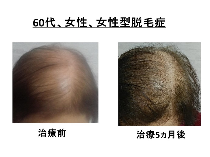 円形脱毛症　病院